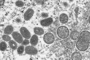 Image of monkeypox virus under an electron microscope. (Photo: AFP/VNA)