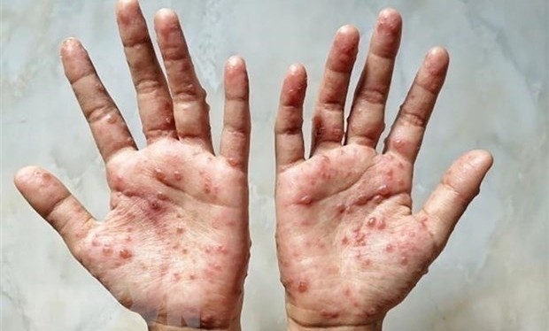 PM Pham Minh Chinh has urged stronger efforts to prevent monkeypox. (Image for illustration/Source: VNA)