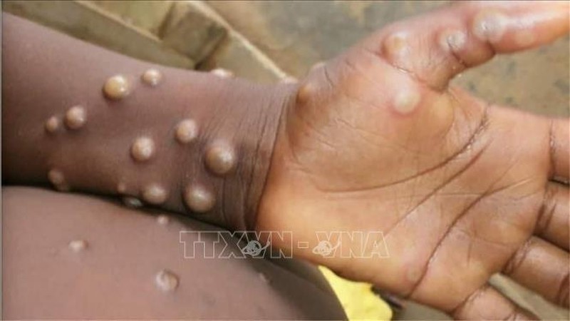 Monkeypox can create lesions on the skin. (Photo: Getty Images/VNA)